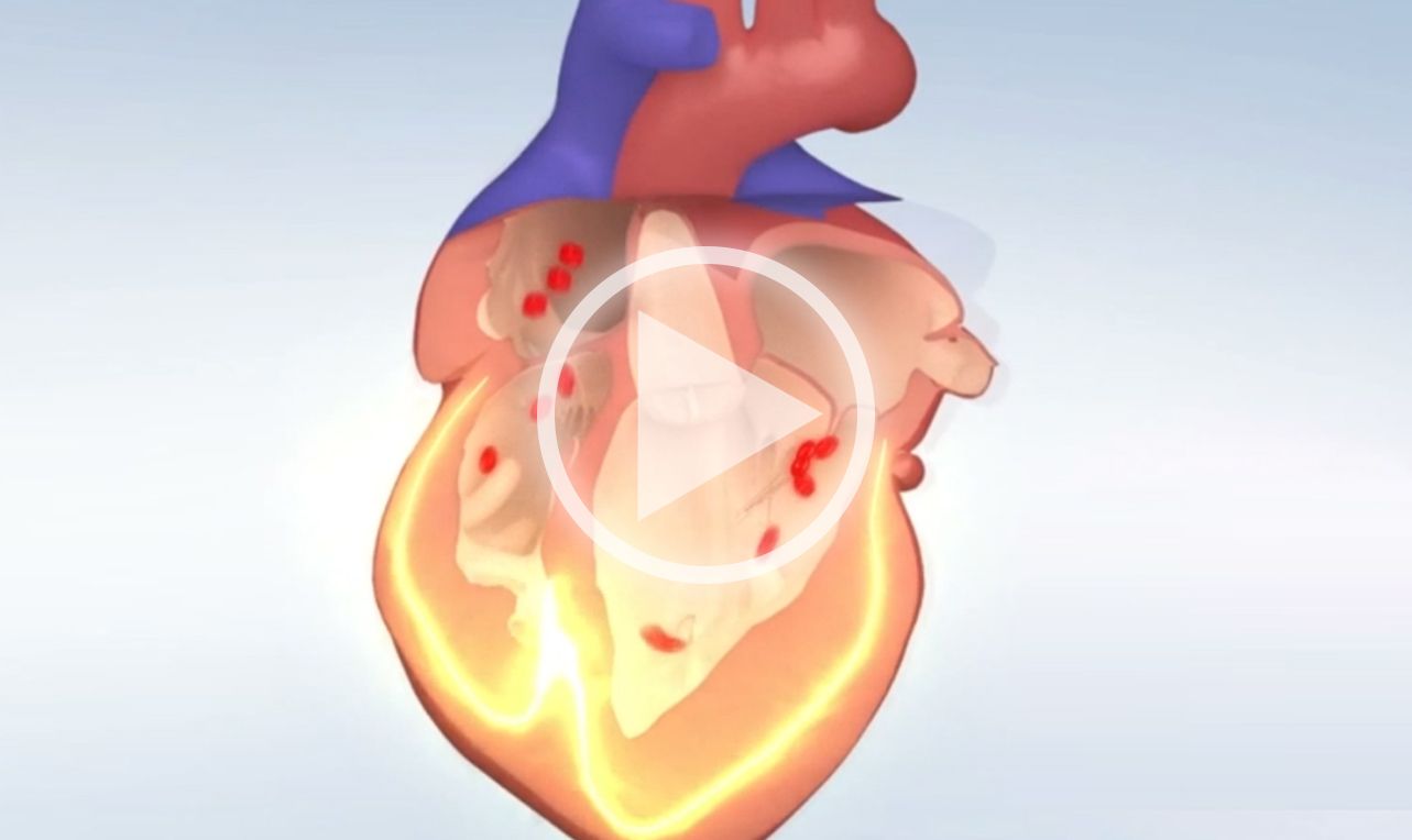 Premature Contraction (PC)